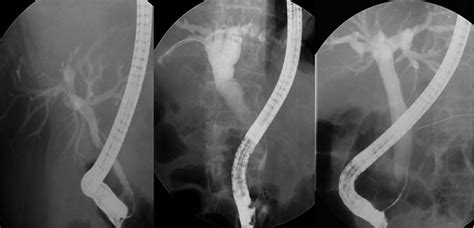 Ercp Findings For The Cbd Malignant Obstruction Group Group B Showing