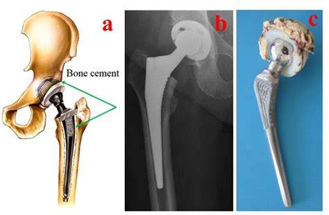Materials Free Full Text Bone Cements Used For Hip Prosthesis