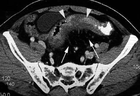 B True Positive Ct Scan For Serosal Invasion Arrows Of Tumor Mass Of