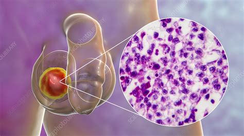 Testicular Cancer Illustration And Light Micrograph Stock Image