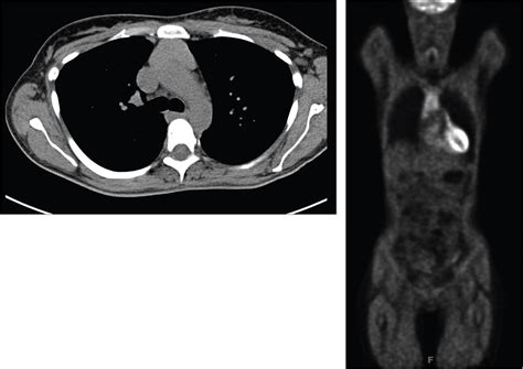 Enlarged Thymus In A Patient With Dyspnea And Weight Loss