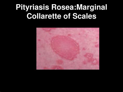 Pityriasis Rosea Collarette Scale