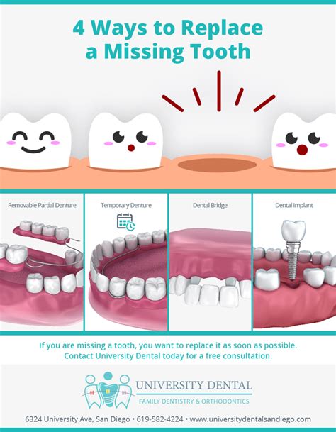 4 Ways To Replace A Missing Tooth University Dental San Diego
