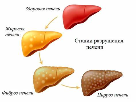 Диета болезнь печени Алкогольная болезнь печени. Алкогольный гепатит. | «Наш лецитин» Алкогольная болезнь печени. Алкогольный гепатит. | «Наш лецитин» Диета болезнь печени