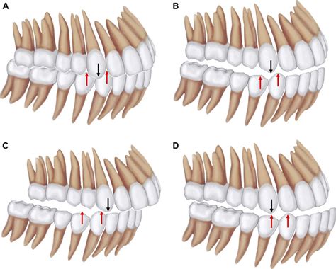 Fig 9 Canine Classification A Class I Canine With The Maxillary