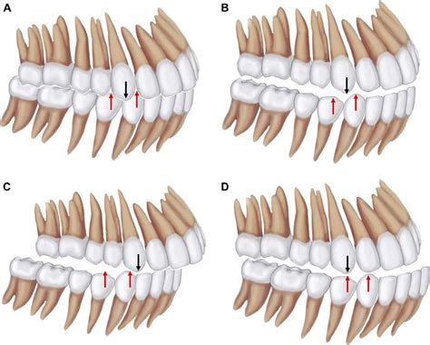 Canine Classification A Class I Canine With The Maxillary Canine