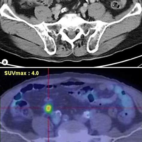Abdominal Ct Scan Showed Swollen Regional Mesenteric Lymph Node