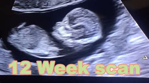 Cute And Clear Ultrasound Of Baby Micah 12 Week Scan Youtube