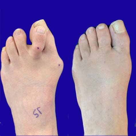 Before And After Bunion Surgery Photos Northwest Surgery Center