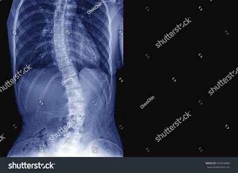 4136 Spine Bend Images Stock Photos And Vectors Shutterstock