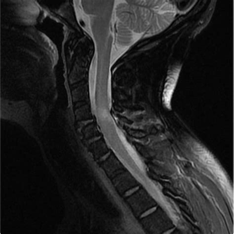 Sagittal Ct Scan Of The Cervical Spine Showing An Ankylosed Spine
