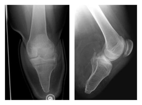 Ap And Lateral Radiographs Showing Below Knee Amputation Stump With