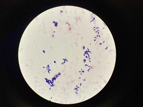 Cureus A Case Of Candida Auris Candidemia In An Immunocompetent