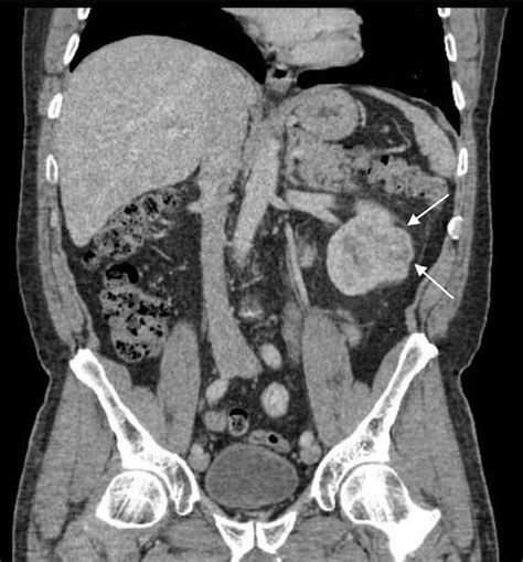Coronal Contrast Enhanced Ct Of The Abdomen Shows The Solid Enhancing