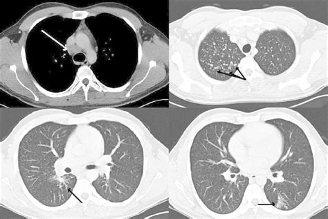 Mediastinal Lymph Nodes X Ray