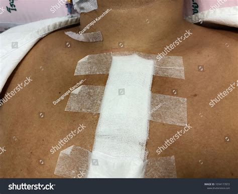 Wound Sternum Dry Dressing Health Wound Stock Photo 1034177872