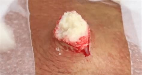 Incision And Removal Of A Sebaceous Cyst On The Back New