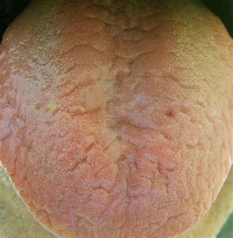 Scrotal Tongue Pictures Causes Treatment And Cure