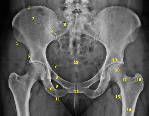 Pelvic Bone Anatomy Radiology Pelvis Annotated Frontal Projection My XXX Hot Girl