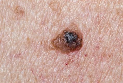 What Is Skin Cancer Causes Pictures Types And More