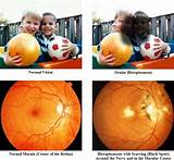 Ocular Histoplasmosis Treatment With Avastin Photos
