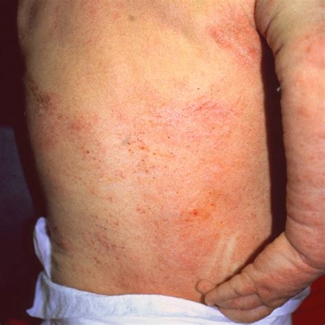 Severe Eczema The Clinical Advisor