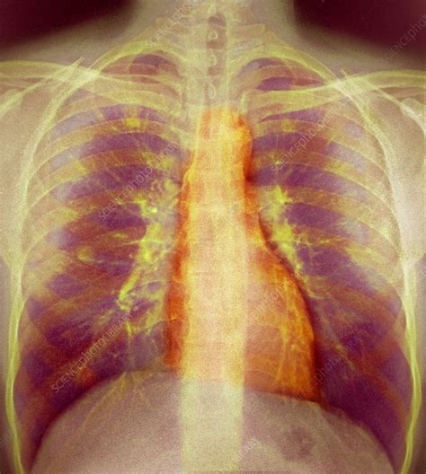 View 2 071 nsfw pictures and enjoy xray with the endless random gallery on scrolller.com. Breathing, X-ray - Stock Image - P590/0235 - Science Photo Library