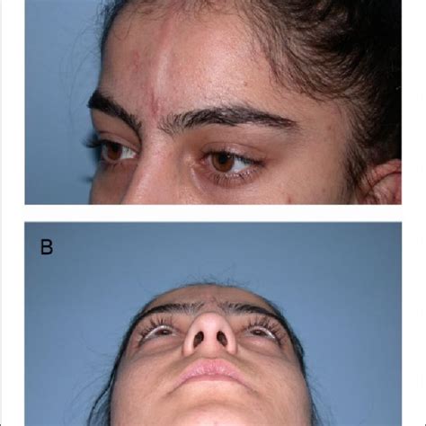 Preoperative View Of The Patient Of Linear Scleroderma A Depressed
