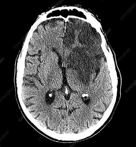 Haemorrhagic Stroke Ct Stock Image C0394290 Science Photo Library