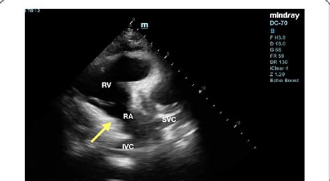 Transthoracic Echocardiogram Tte Of Right Ventricle Inflow View