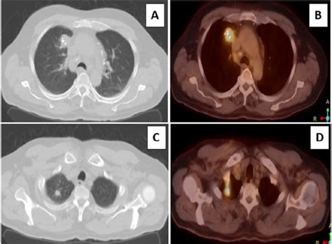 PET Positive Lung Mass In A Patient With Rectal Cancer BMJ Case Reports