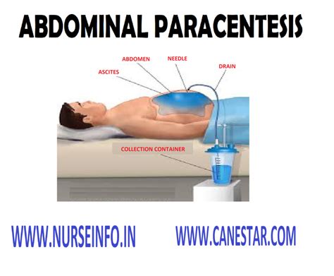 Abdominal Paracentesis Nurse Info