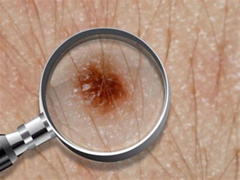 Skin Cancer Or Mole How To Tell Harmless Moles From Deadly