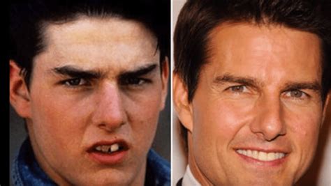 Tom Cruise Teeth Before And After Celebrity Teeth Before And After Smile Makeovers BT Lea