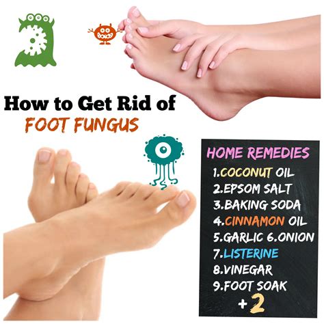 How To Get Rid Of Foot Fungus 11 Athletes Foot To Happy Feet