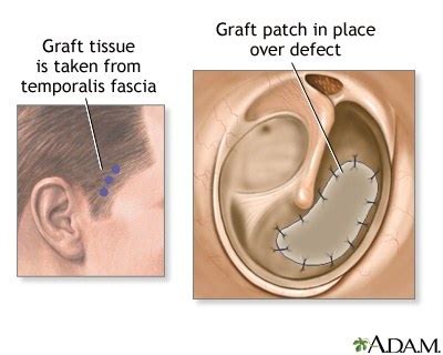A perforated eardrum is a tear or hole in the ear's tympanic membrane (the medical name for your eardrum). What happens if you touch your eardrum with a Q-Tip? - Quora