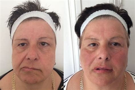 Bells Palsy Victim Reveals How She Is Smiling For Pictures Again