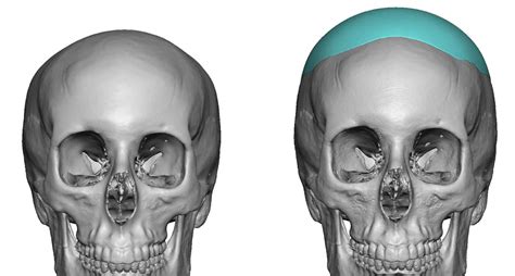 Blog Archivecase Study Custom Crown Skull Implants For Women