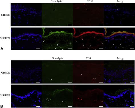 Generalized Bullous Fixed Drug Eruption Is Distinct From Stevens