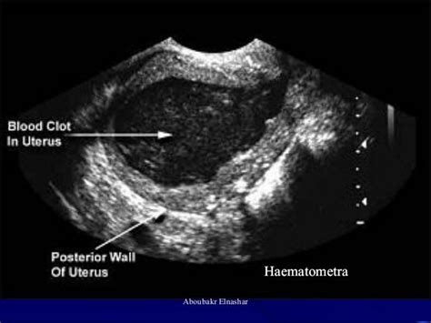 Ultrasonography Of The Uterus