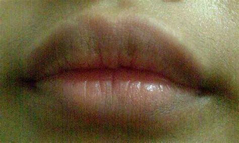 Lip Discoloration Pictures Causes Treatment Remedies
