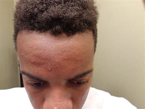 さめはだ rough skin) is an ability introduced in generation iii. Skin Concerns How to improve scaly forehead texture ...