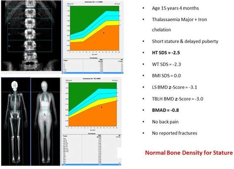 Bone Density In Children What Are We Measuring Archives Of Disease