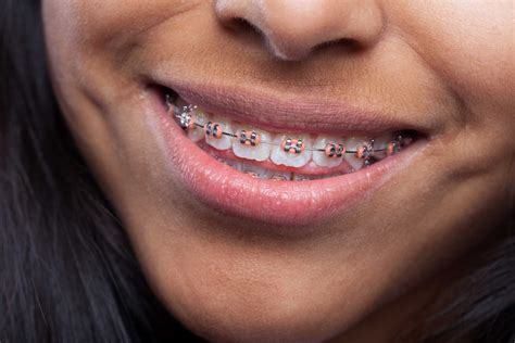 What Are Spacers For Braces Everything You Need To Know