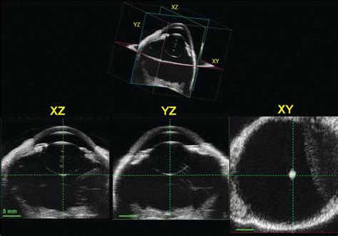 A Brief Overview Of Ophthalmic Ultrasound Imaging Intechopen