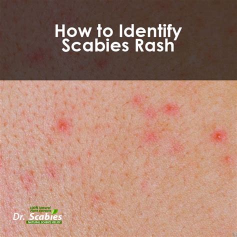 How To Identify Scabies Rash Drscabies