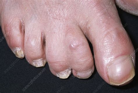 Webbed Toes Stock Image M350 0266 Science Photo Library