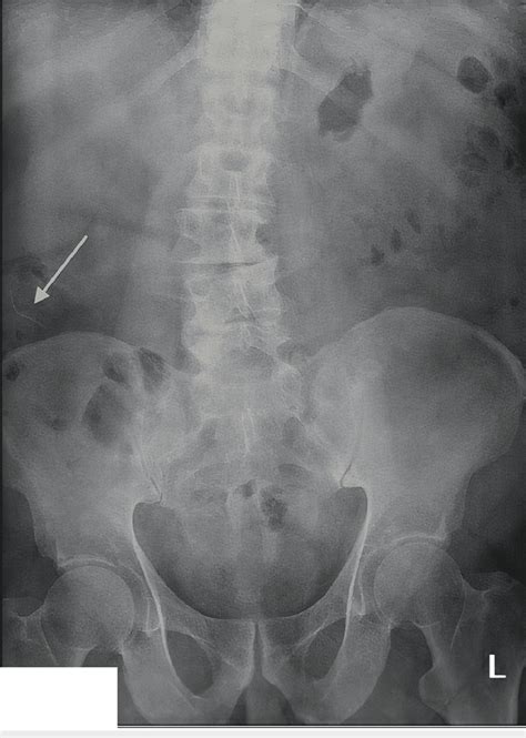 Pre Operative Abdominal Radiograph Demonstrating A Curvilinear Density