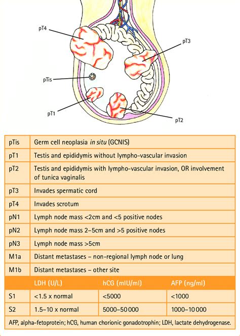 Diagram And Summary Of Tnm Staging For Testicular Cancer Drawing By