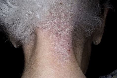 Severe Psoriasis Pictures 2 Symptoms And Pictures